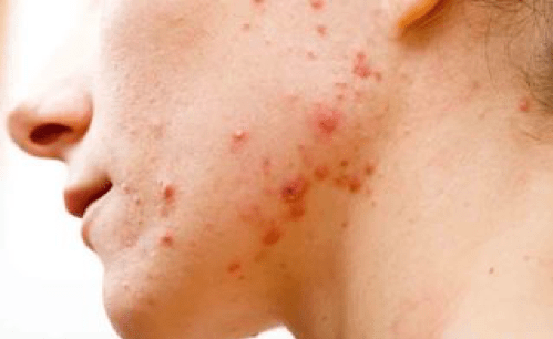 Acne Vulgaris e dieta chetogenica