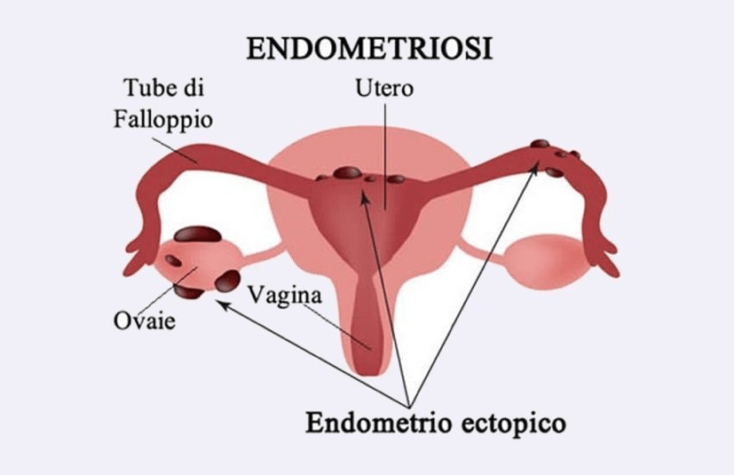 Endometriosi e dieta chetogenica